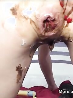Prolapse
